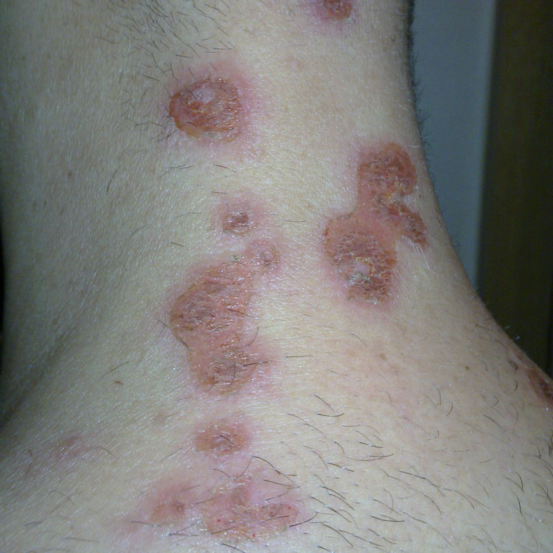 Skin Infection Narberth Pa Dermatologist